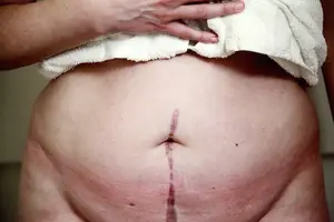 舒缓孕妇腰痛 美好孕期从腰部护理开始