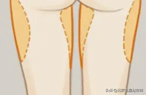 大腿如何吸脂？ 腿部大腿抽脂方法有哪些？