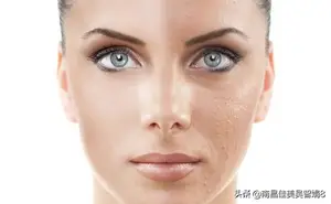 激光祛斑后注意事项？ 激光祛斑后注意事项？