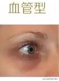 怎么去黑眼圈？ 黑眼圈怎么办？
