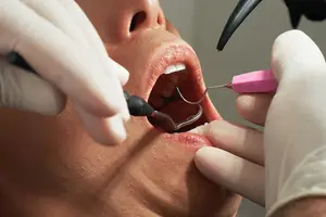 牙龈肿不是问题,补牙我最行! 牙龈肿不是问题,补牙我最行!