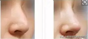 拱鼻是什么意思？ 朝天鼻的形成原因是什么呢？