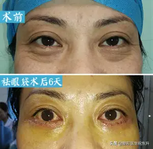 眼袋可以有什么办法去掉？ 眼袋如何消除？