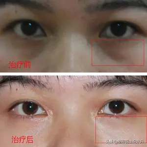 眼袋可以有什么办法去掉？ 眼袋如何消除？