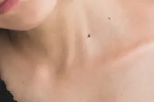 解决结痤难题，有效治疗结痤