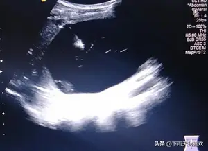 肝囊肿最佳治疗方法？ 肝上有囊肿怎么解决？