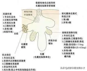 痤疮怎么治疗？ 长痤疮怎么治疗