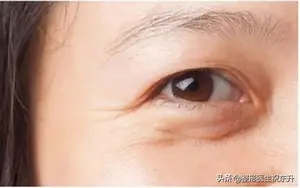 眼袋怎么去除？ 怎样祛眼袋？