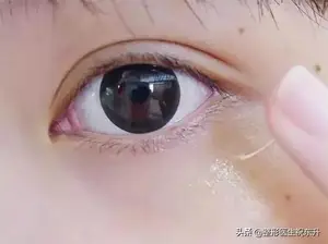 眼袋怎么去除？ 怎样祛眼袋？