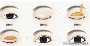 双眼皮做哪种好？ 双眼皮手术哪种最好？
