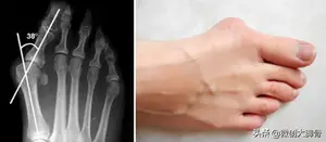 大脚骨是怎么回事？ 大脚骨是怎么造成的？