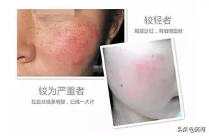 脸上有红血丝怎么办？ 脸上有红血丝怎么办