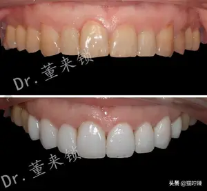 四环素牙是什么意思？ 什么是四环素牙？成人吃四环素药会不会得四环素牙？