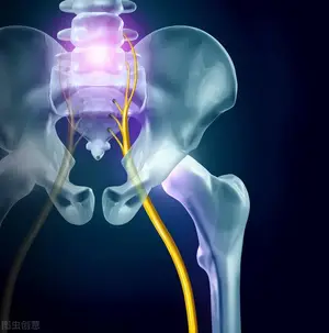 坐骨神经疼是什么原因引起的？ 坐骨神经痛是由什么引起的？
