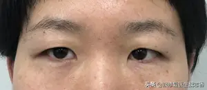 割双眼皮多久会恢复？ 割双眼皮要多久恢复？
