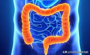 肠癌的症状和前兆是怎样的？ 肠癌的早期症状和前兆