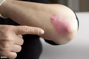牛皮癣可以治愈的吗？ 牛皮癣能够治愈吗？