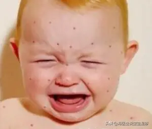 婴儿湿疹怎么办，婴儿湿疹最佳护理方法？ 什么是婴儿湿疹