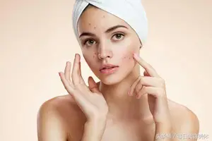 美容护肤：女人长痘痘后留有痘印应该怎么护理呢？