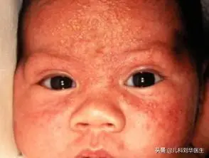 新生儿痤疮是怎么回事 ？ 新生儿脓疱疹怎么办？