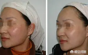 激光能祛黄褐斑吗？ 激光能去除黄褐斑吗？