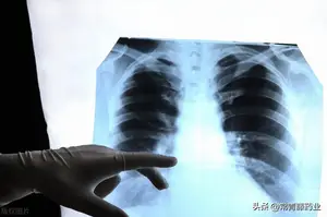 白肺到底是什么？有这些征兆之后，病毒可能就已经进入肺部了