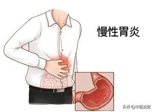 中医界的万能方-小柴胡颗粒，还有这8种用法，建议收藏