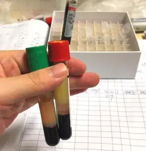 什么是胰腺炎？得了胰腺炎该怎么办？胰腺炎能留下后遗症吗？一篇文章消除您对胰腺炎的“胰”惑