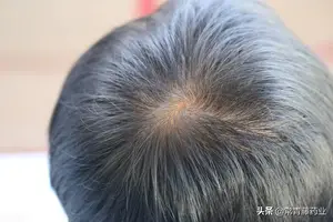 非那雄胺服用3个月至10年会怎么样？几组数据，分别告诉你答案