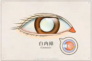 了解常见的老年眼病-白内障 了解常见的老年眼病-白内障