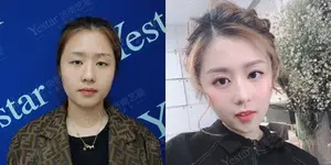 揭秘玻尿酸“骗局”！真正懂玻尿酸的女人，都是高手