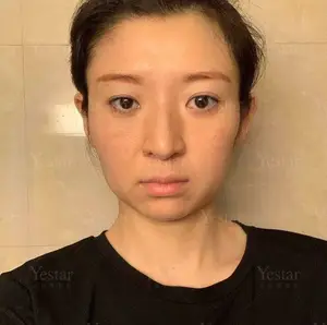 揭秘玻尿酸“骗局”！真正懂玻尿酸的女人，都是高手