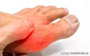 非布司他是防治痛风的常用药，可以长期服用，但需要注意这4点