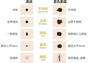 普通痣和黑色素瘤，如何科学辨别