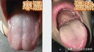 仲景护嗓名方，三味药温阳化痰，轻松搞定咽炎、喉炎、扁桃体炎