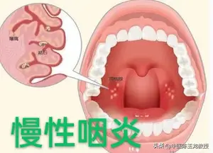 仲景护嗓名方，三味药温阳化痰，轻松搞定咽炎、喉炎、扁桃体炎