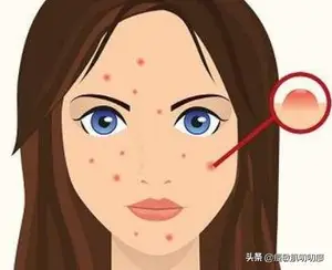 玫瑰痤疮最佳的治疗方法？ 脸上长了痤疮应该怎样治疗？