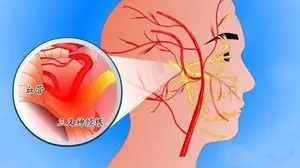 「健康科普」正确认识天下第一痛-三叉神经痛