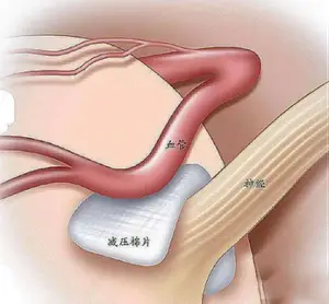 「健康科普」正确认识天下第一痛-三叉神经痛