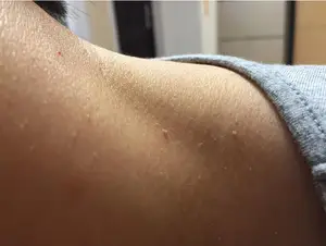 脖子和腋下的“小肉粒”是什么？能用手揪掉吗？一文告诉你答案