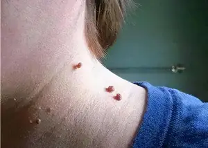 脖子和腋下的“小肉粒”是什么？能用手揪掉吗？一文告诉你答案