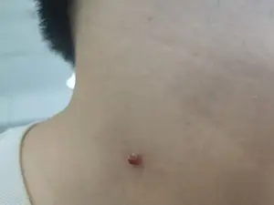 脖子和腋下的“小肉粒”是什么？能用手揪掉吗？一文告诉你答案