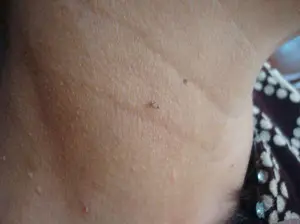 别忽视脖子上的“小颗粒”，注意，这是丝状疣！一招教你变光滑