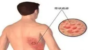 常见皮肤病的联合用药，呼吸道疾病的联合用药，值得收藏