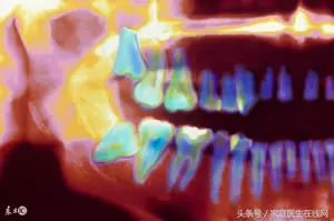 它是口腔埋的定时炸弹，发炎不拔可致毁容！