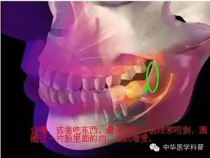 说说智齿的那些事儿