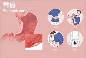 「健康科普」胃癌早期的五大症状