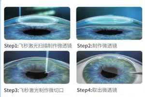 近视手术流程？ 近视眼手术有哪几种？