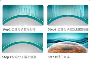 近视手术流程？ 近视眼手术有哪几种？