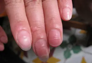 指甲凹陷是什么原因？ 指甲上有凹陷是怎么回事？